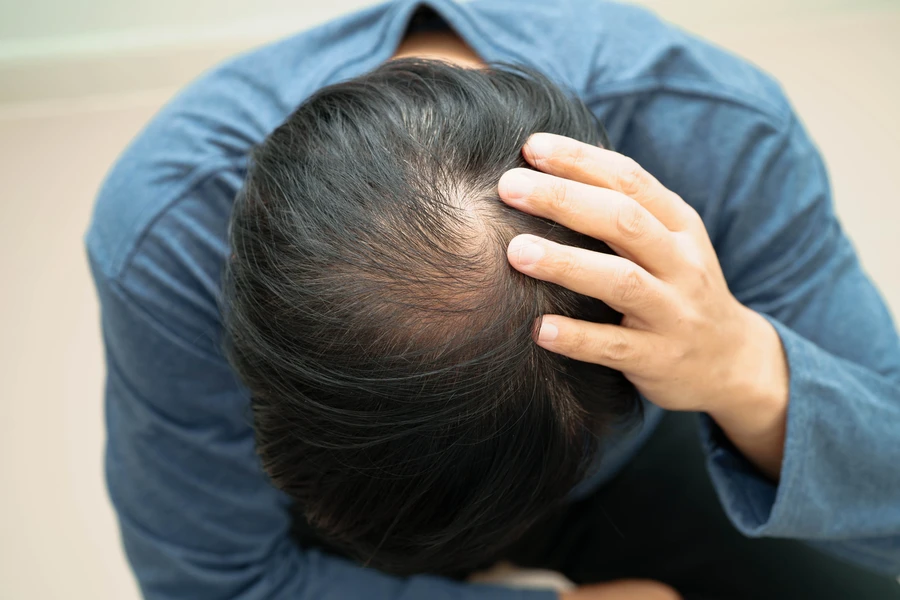 Affordable Alopecia Treatment Houston, TX Affordable Alopecia Treatment Houston, TX