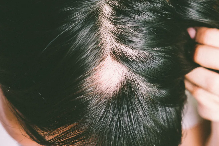 Preventing Further Hair Loss Through Consistent Alopecia Care Houston, TX Preventing Further Hair Loss Through Consistent Alopecia Care Houston, TX