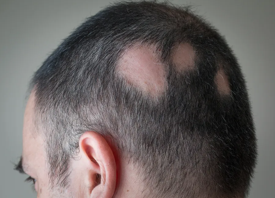 Preventing Further Hair Loss Through Consistent Alopecia Care in Houston, TX Preventing Further Hair Loss Through Consistent Alopecia Care in Houston, TX