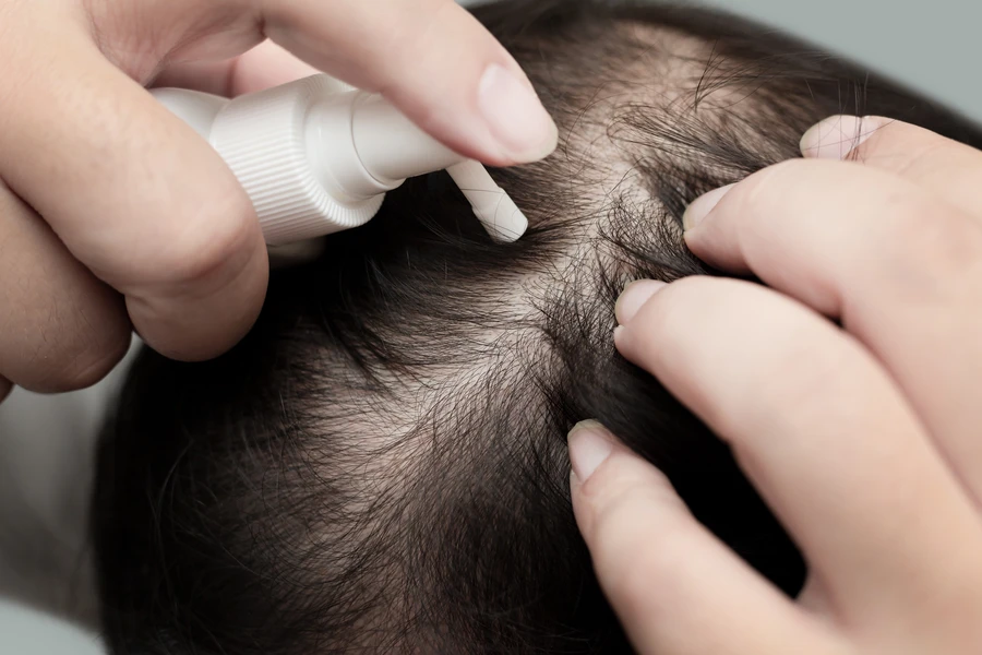 Professional Alopecia Treatment Houston, TX Professional Alopecia Treatment Houston, TX