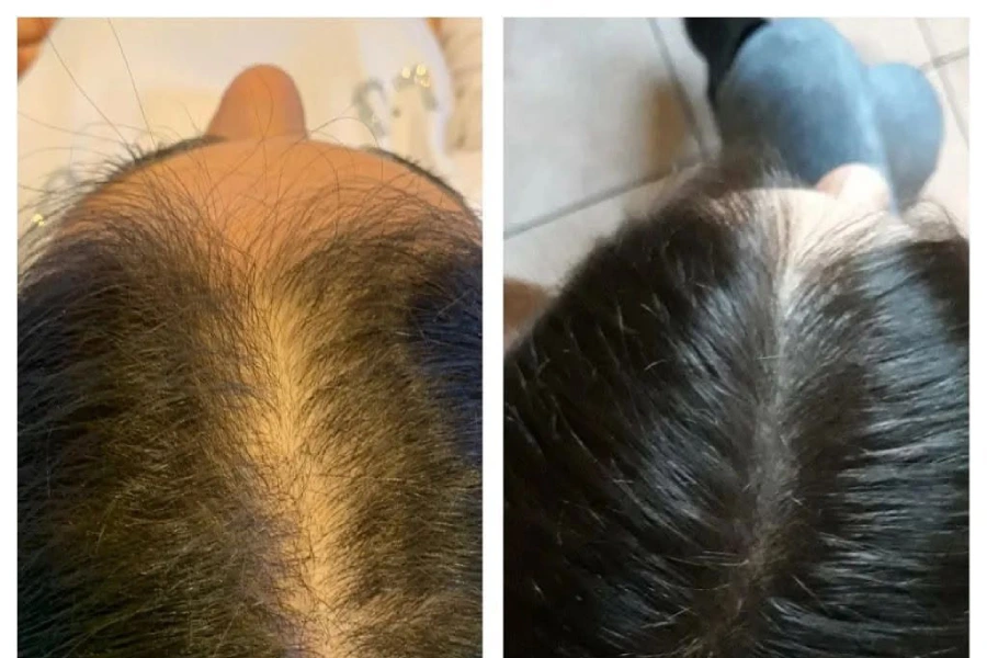 Professional Hair Restoration in Houston, TX Professional Hair Restoration in Houston, TX