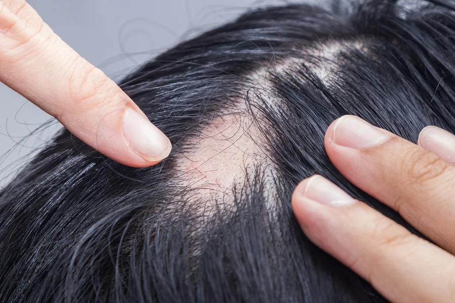 Understanding Different Approaches To Alopecia Treatment Houston, TX Understanding Different Approaches To Alopecia Treatment Houston, TX