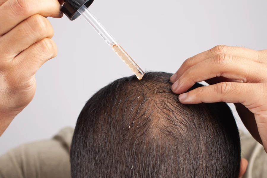Understanding Different Approaches To Alopecia Treatment in Houston, TX Understanding Different Approaches To Alopecia Treatment in Houston, TX